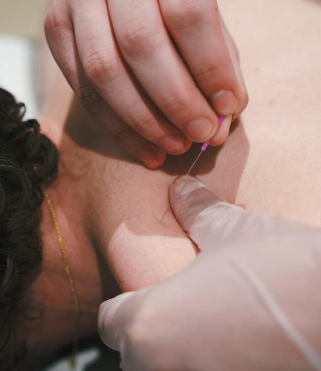 Dry needling Marseille Technique de dry needling pour un patient
