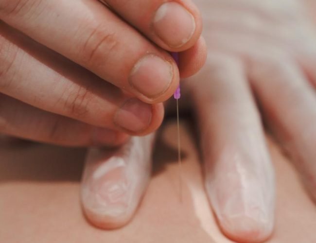 dry needling Gros plan dry needling